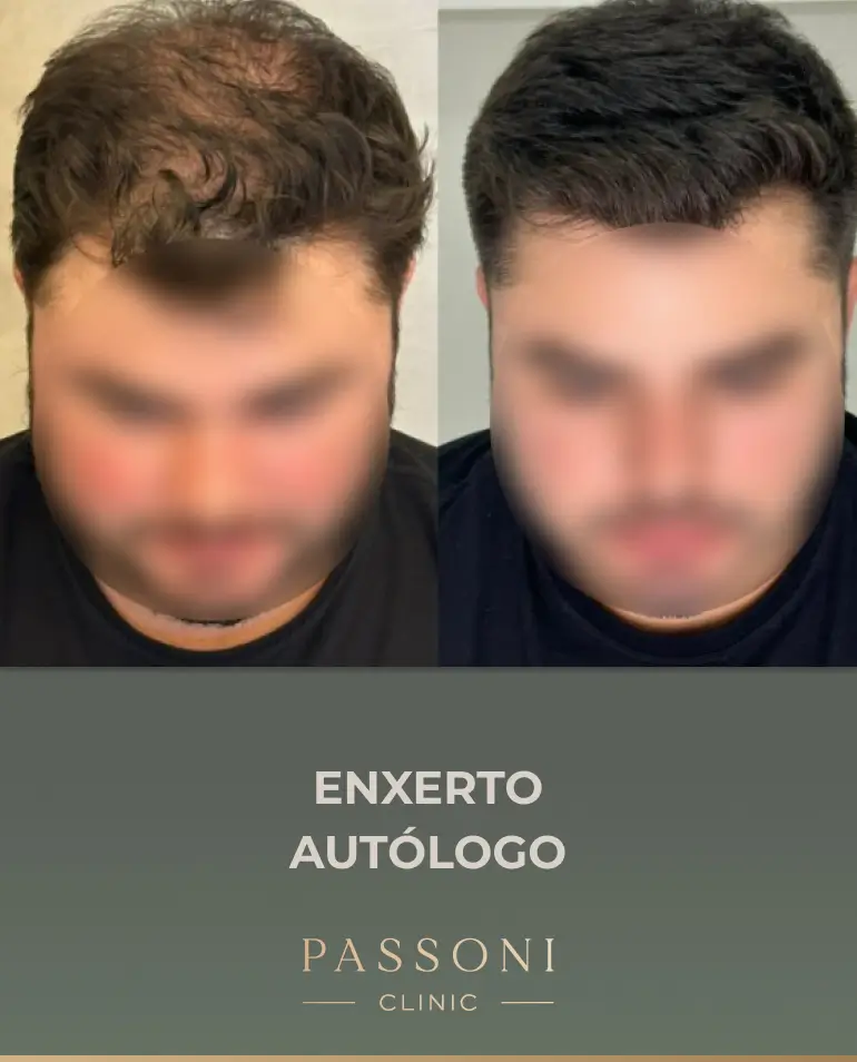 Passoni = antes e depois 01