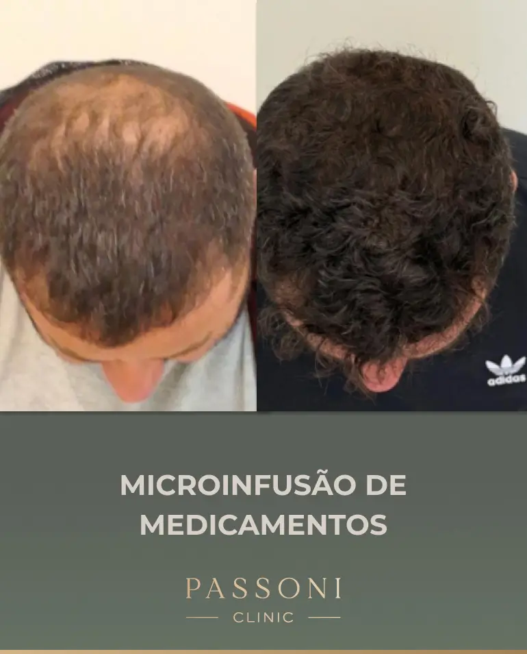 Passoni = antes e depois 02