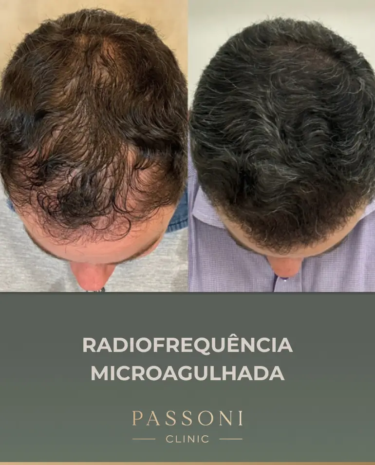Passoni = antes e depois 03