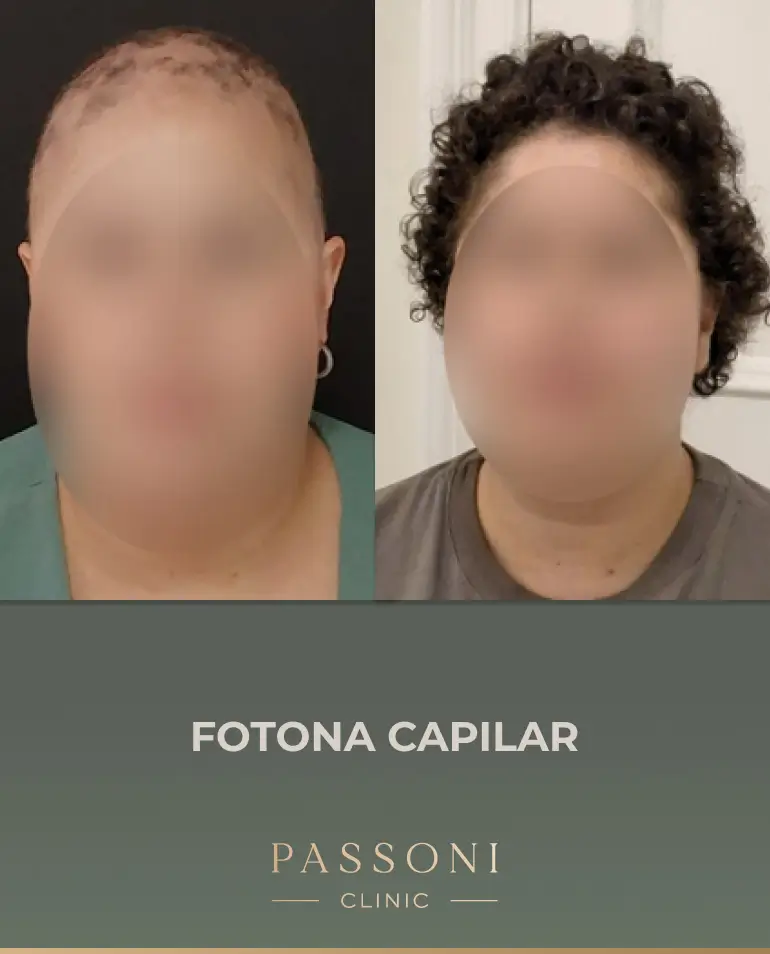 Passoni = antes e depois 04