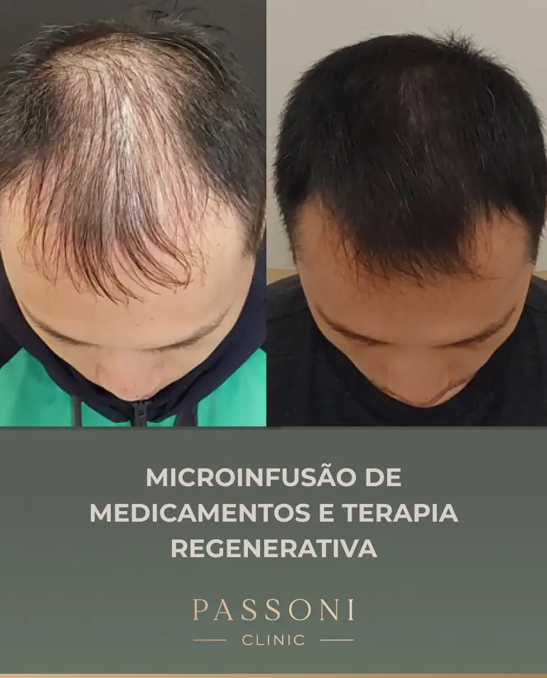 Passoni = antes e depois 05