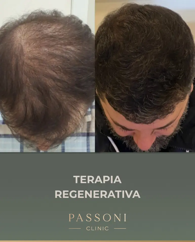 Passoni = antes e depois 06