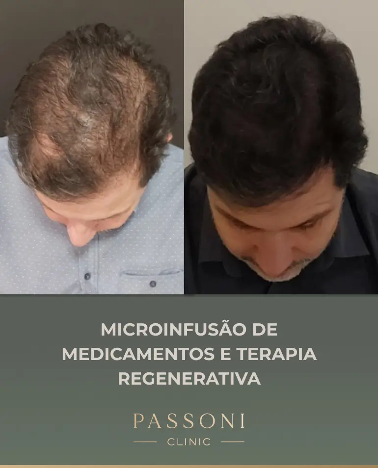 Passoni = antes e depois 07