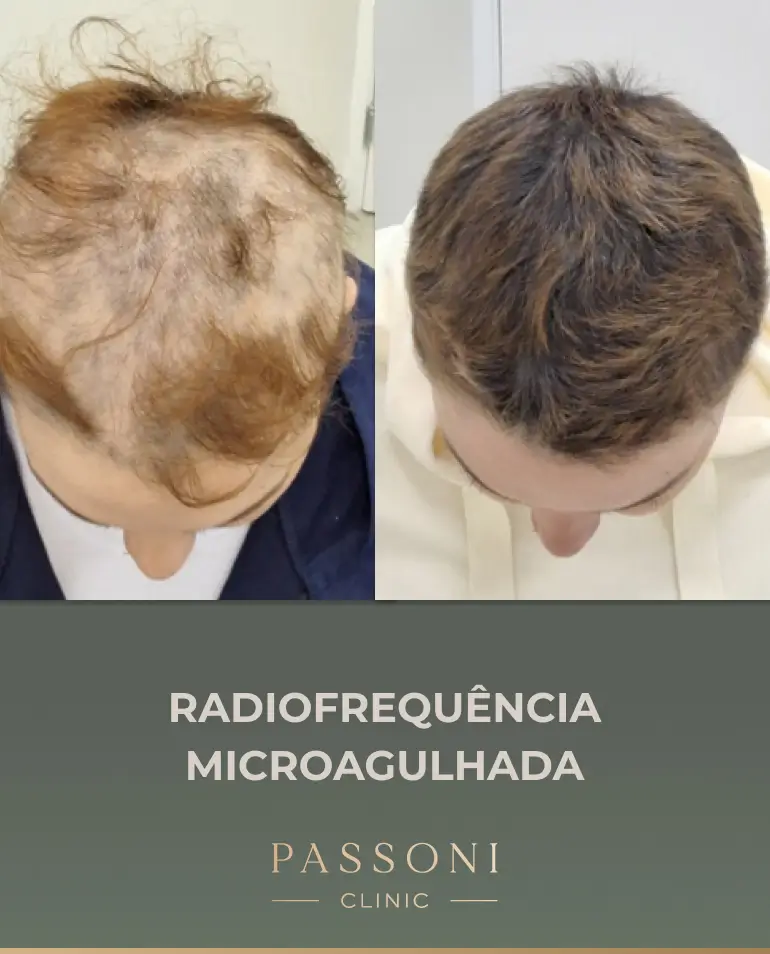Passoni = antes e depois 08