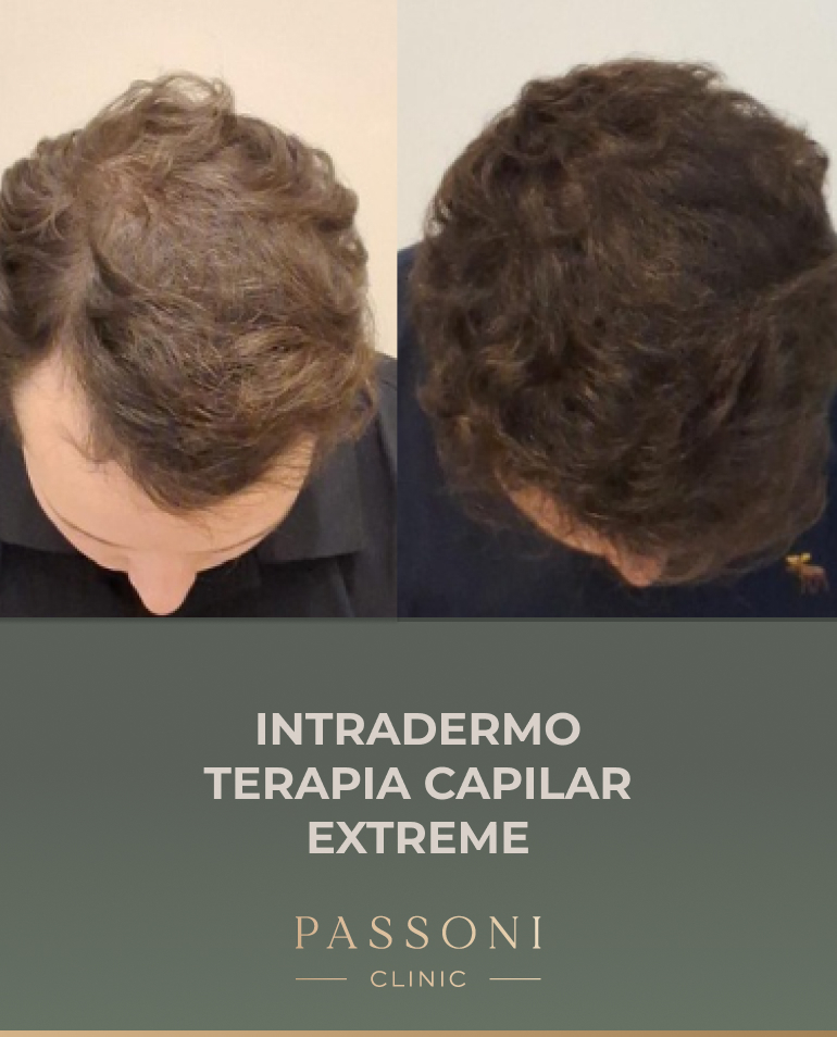 Passoni = antes e depois 09
