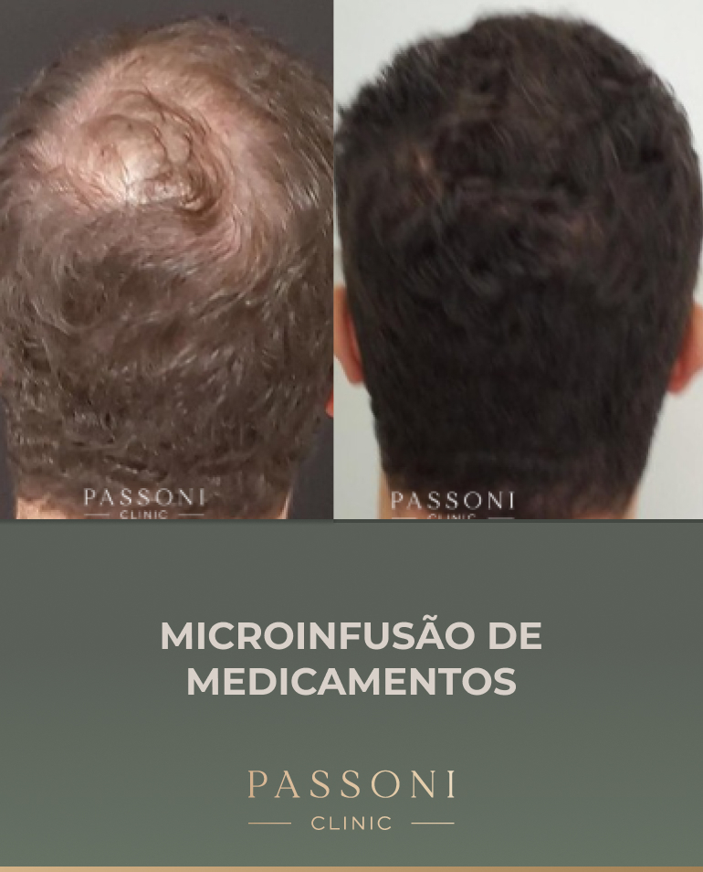 Passoni - antes e depois 10