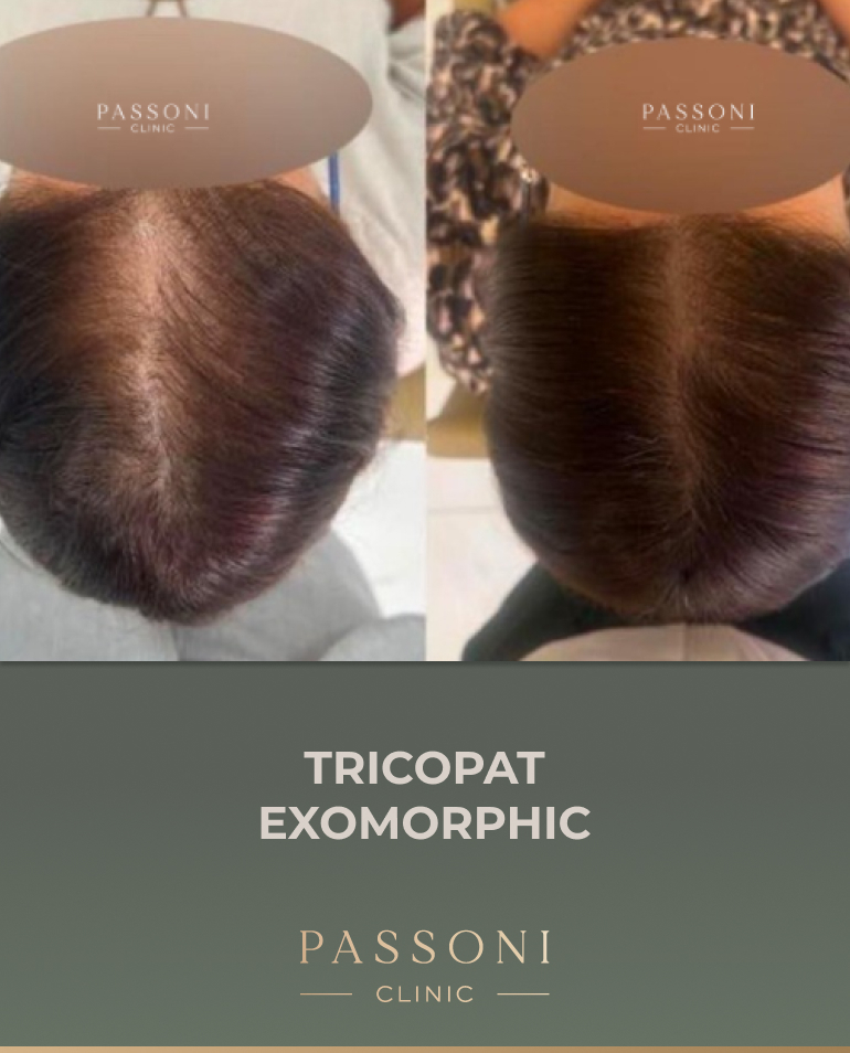 Passoni - antes e depois 11