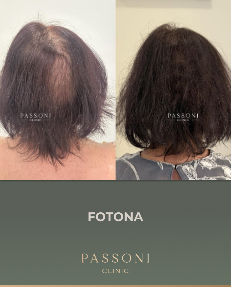 Passoni - antes e depois 12