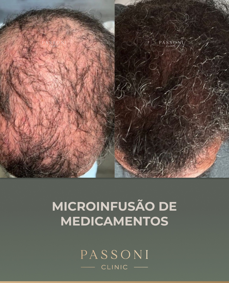 Passoni - antes e depois 13
