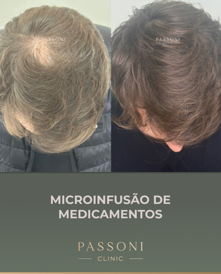 Passoni - antes e depois 14