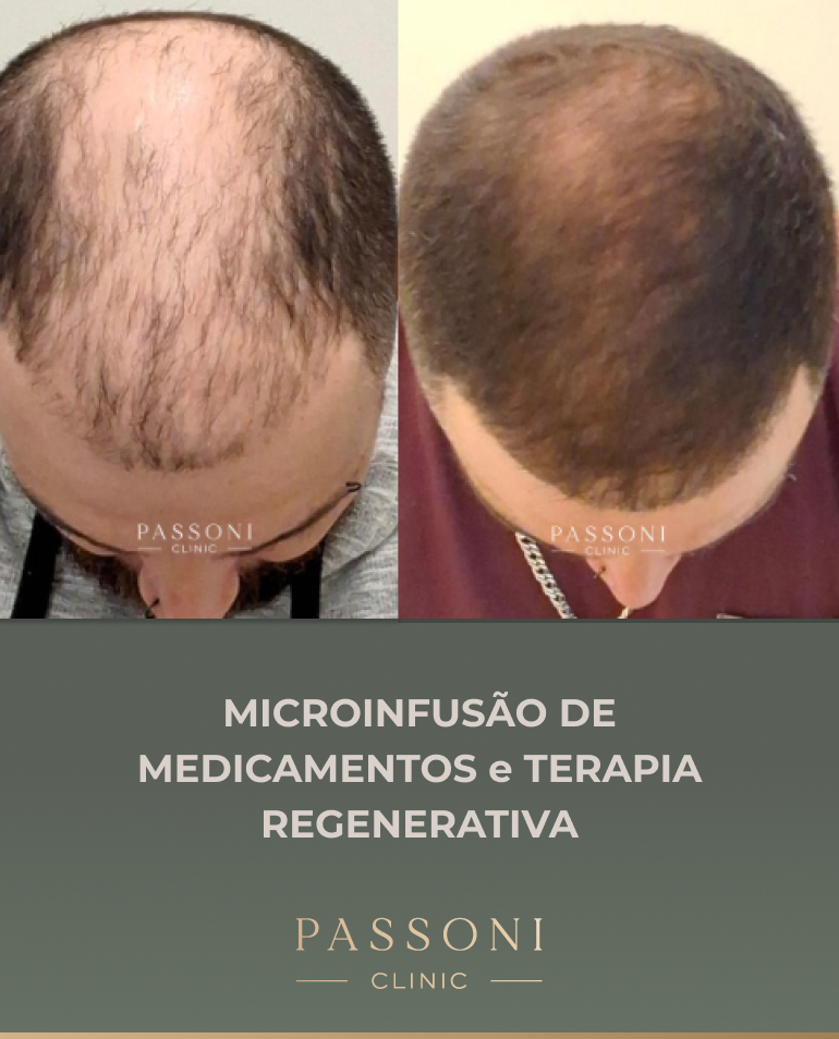 Passoni - antes e depois 15