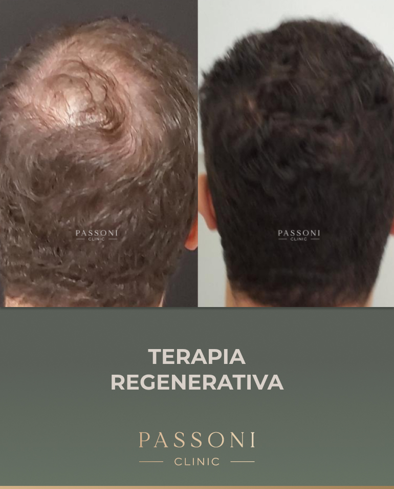 Passoni - antes e depois 16