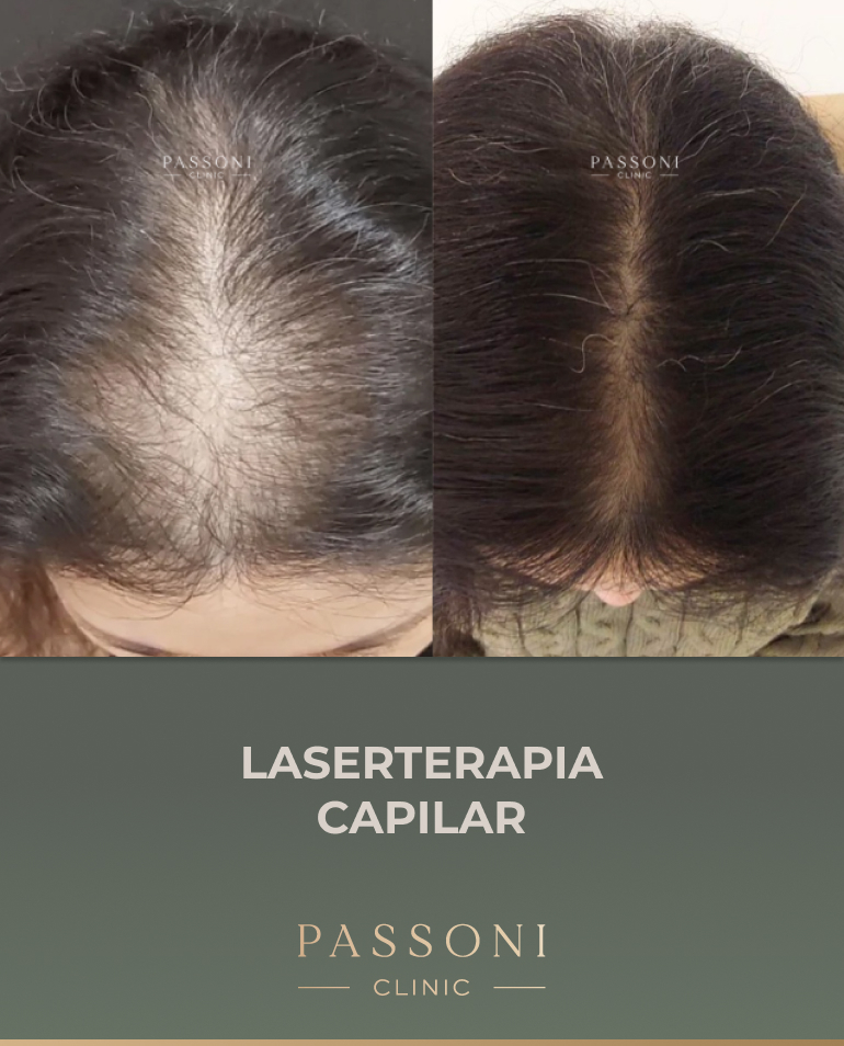 Passoni - antes e depois 17