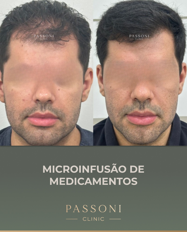 Passoni - antes e depois 18