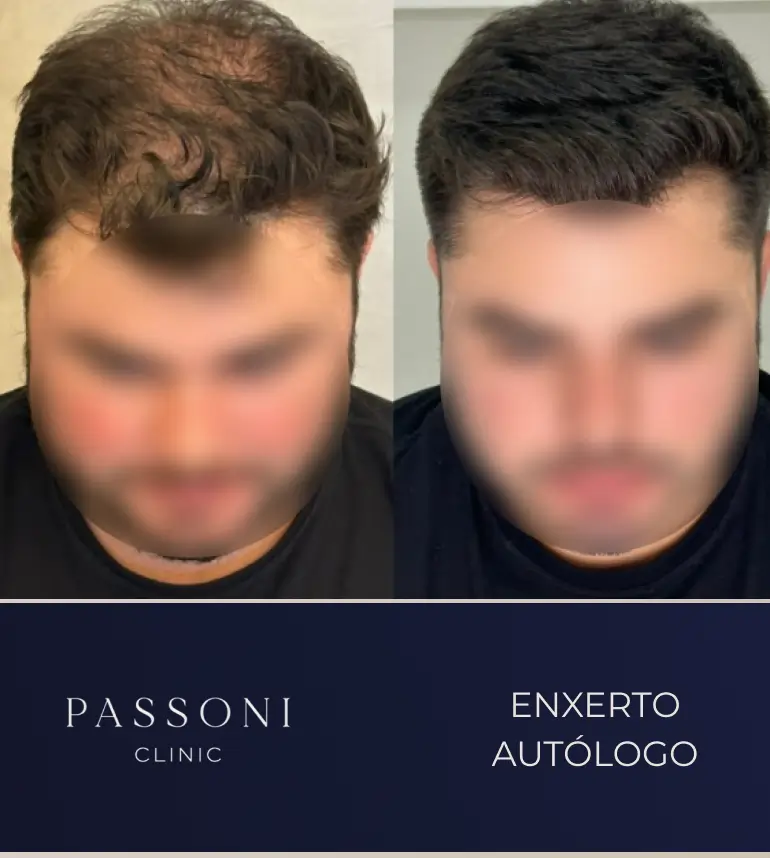 Passoni _ antes e depois 01