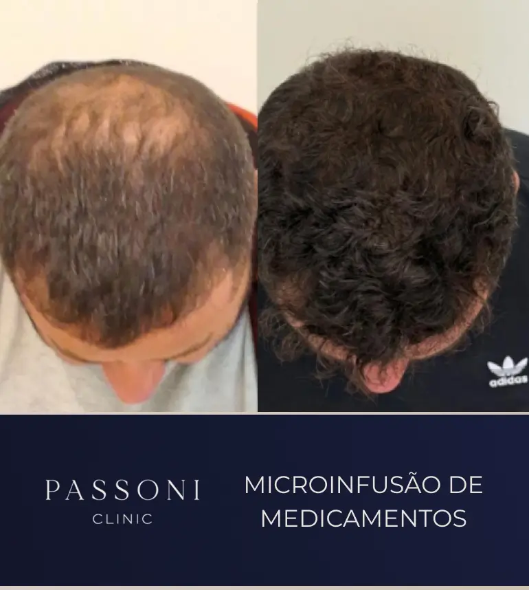 Passoni _ antes e depois 02
