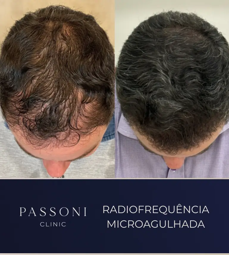 Passoni _ antes e depois 03