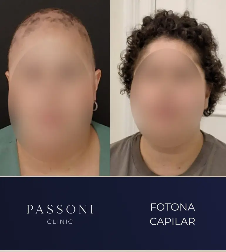 Passoni _ antes e depois 04