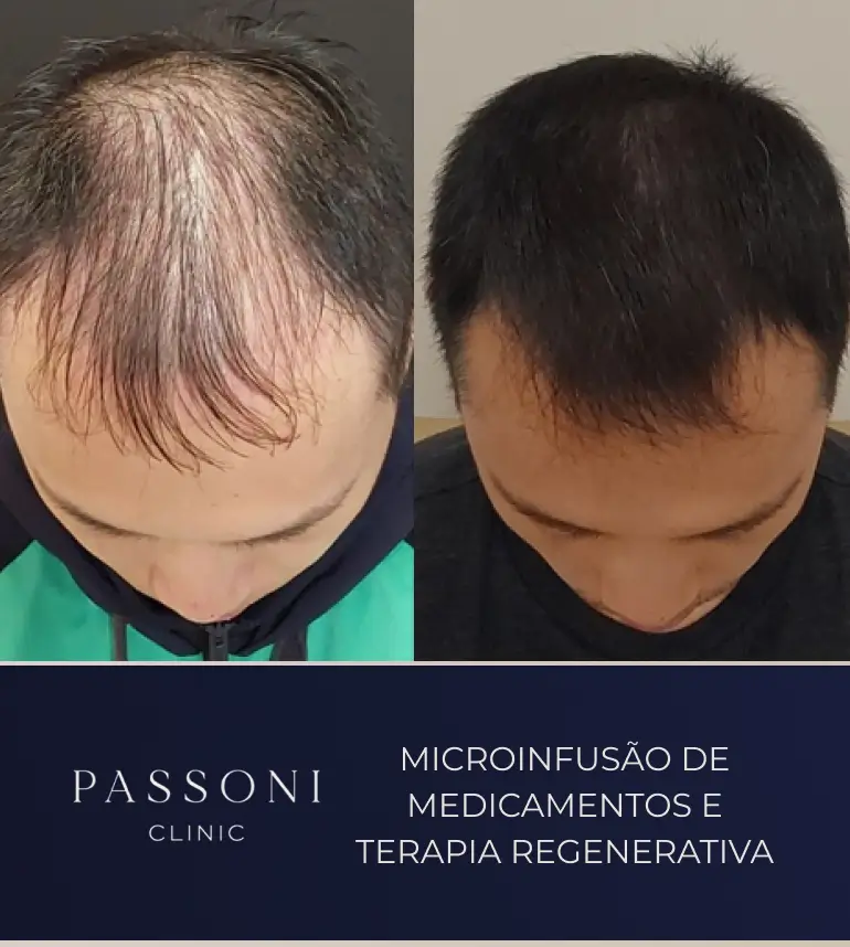 Passoni _ antes e depois 05