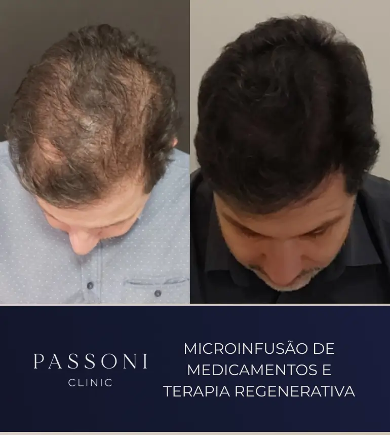 Passoni _ antes e depois 07