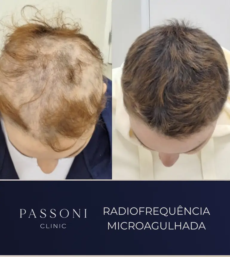 Passoni _ antes e depois 08