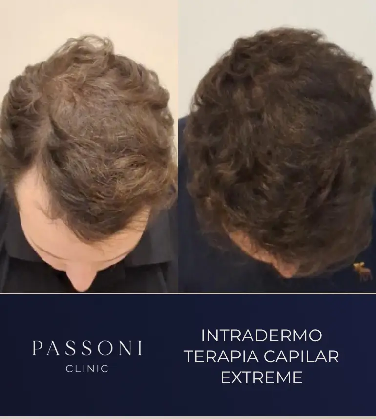 Passoni _ antes e depois 09