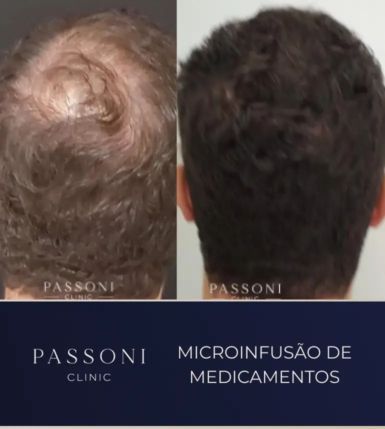 Passoni _ antes e depois 10