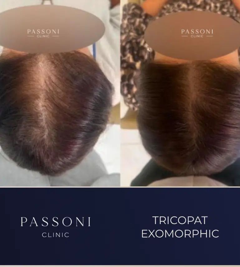 Passoni _ antes e depois 11