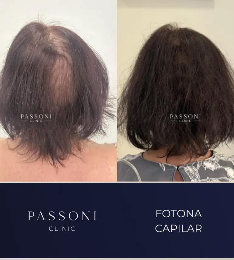 Passoni _ antes e depois 12