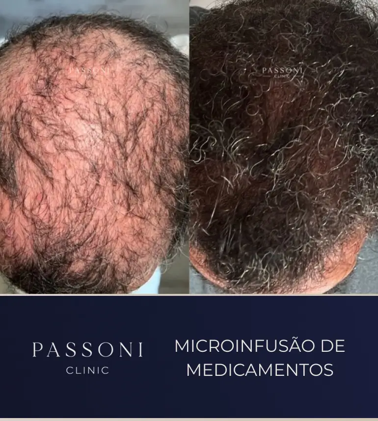 Passoni _ antes e depois 13