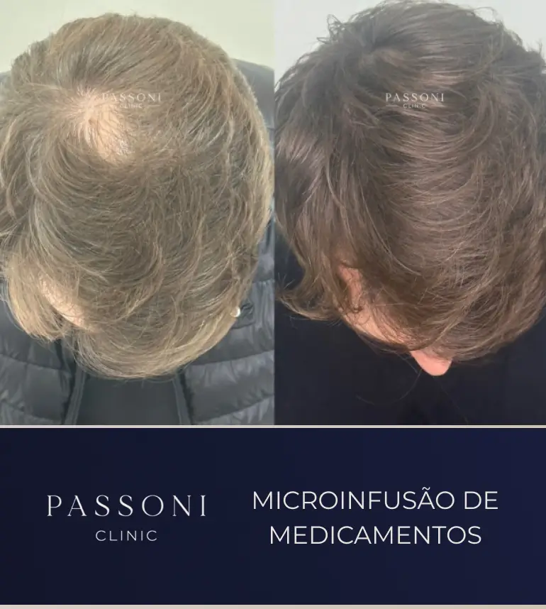 Passoni _ antes e depois 14