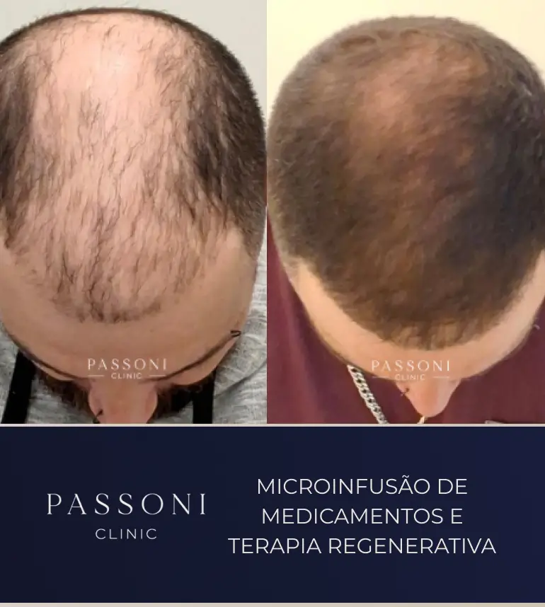 Passoni _ antes e depois 15