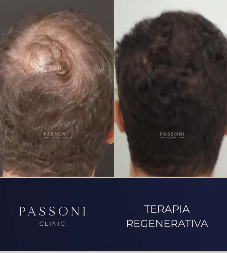 Passoni _ antes e depois 16