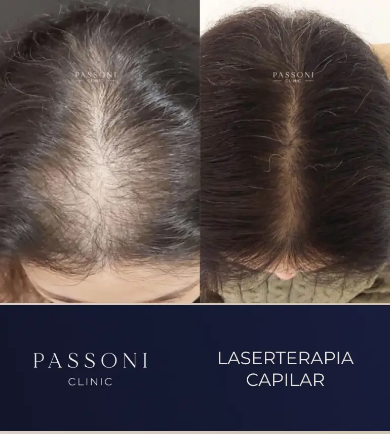 Passoni _ antes e depois 17